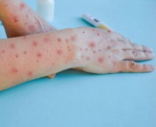 Uzmanlar uyarıyor! El, ayak ve ağız hastalığı okullarda hızla yayılıyor