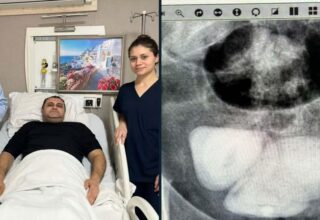 Aydın’da şoke eden olay! Mesanesinden resmen piramit şeklinde taş çıktı