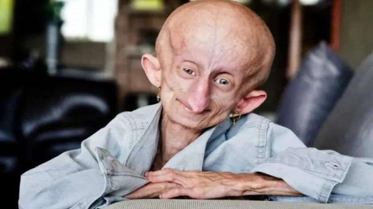 19 yılda 152 yıl yaşlanmıştı: Progeria hastası Beandri Booysen hayatını kaybetti!