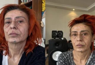 Yüzü yanan Yıldız Tilbe’den radikal karar! İyileşene kadar maske takacak