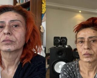Yüzü yanan Yıldız Tilbe’den radikal karar! İyileşene kadar maske takacak