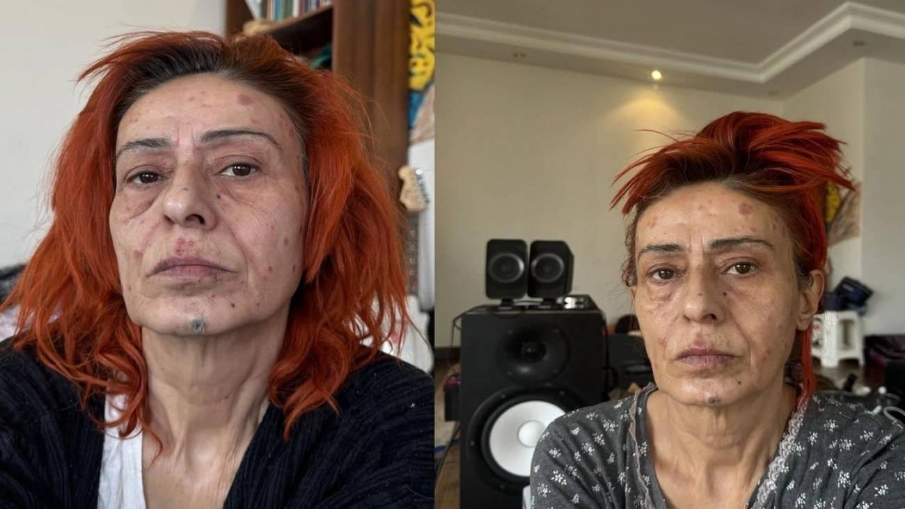 Yüzü yanan Yıldız Tilbe’den radikal karar! İyileşene kadar maske takacak